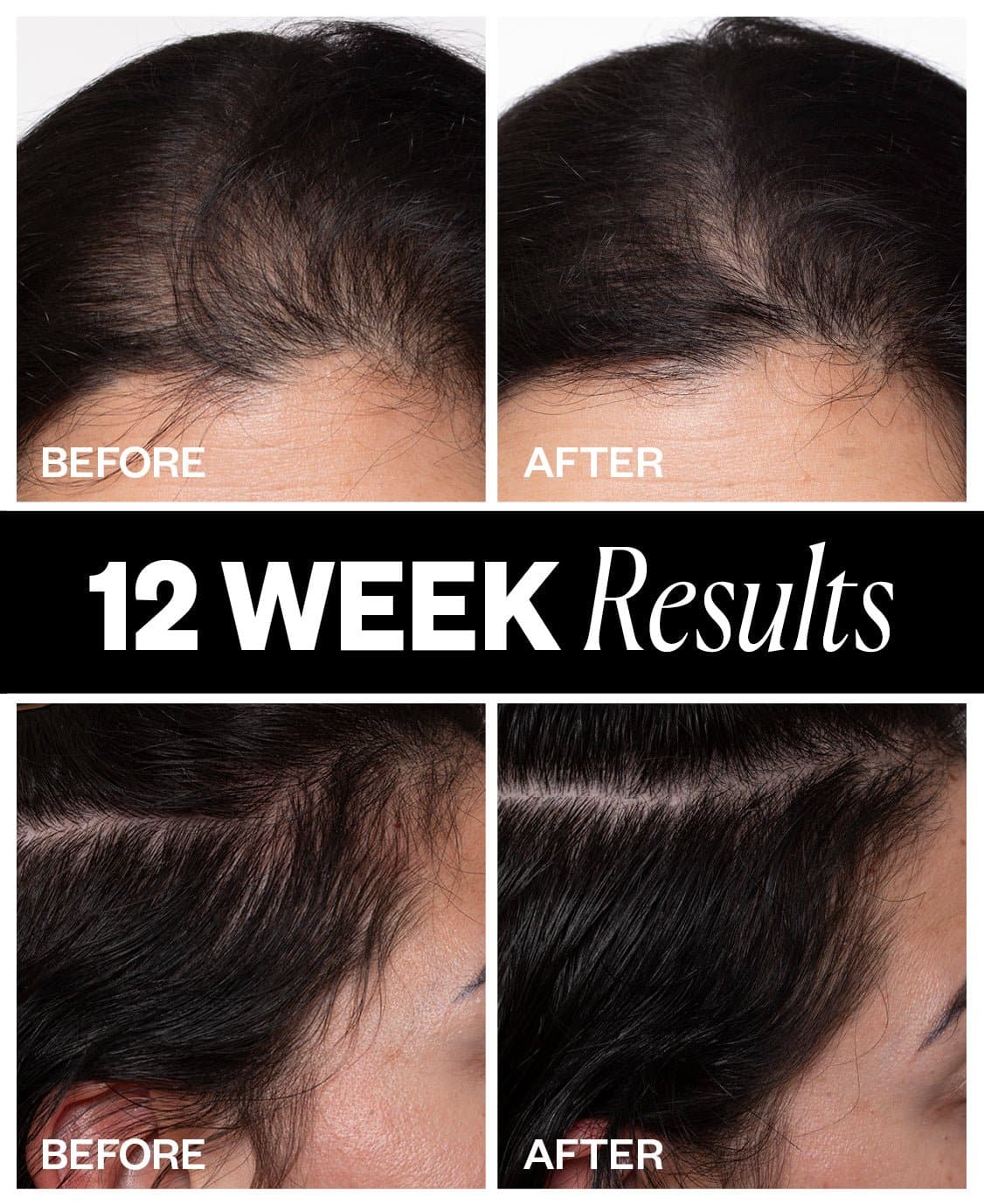 SPONSORED Hair Density Scalp Treatment